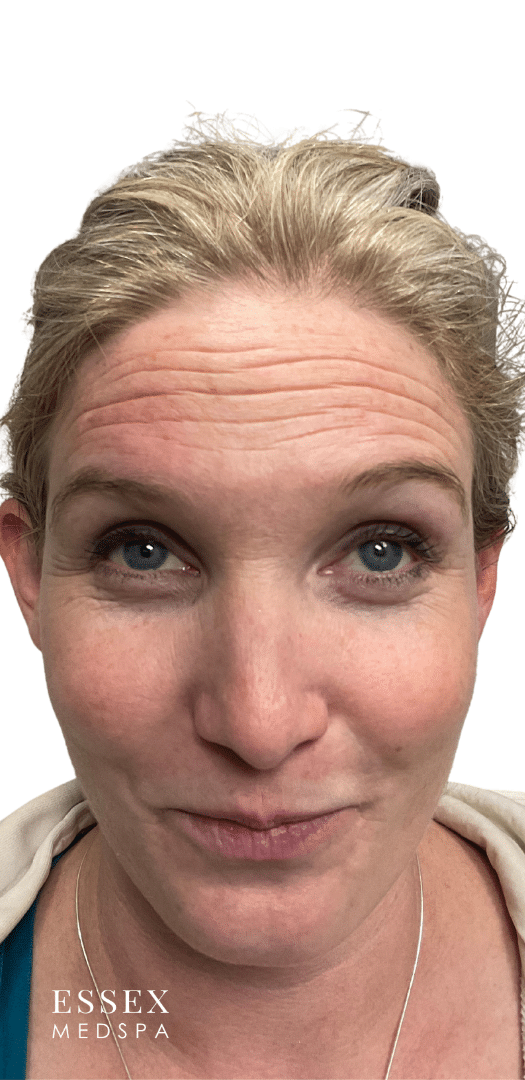 Before Image: Toxin for Facial Lines - front