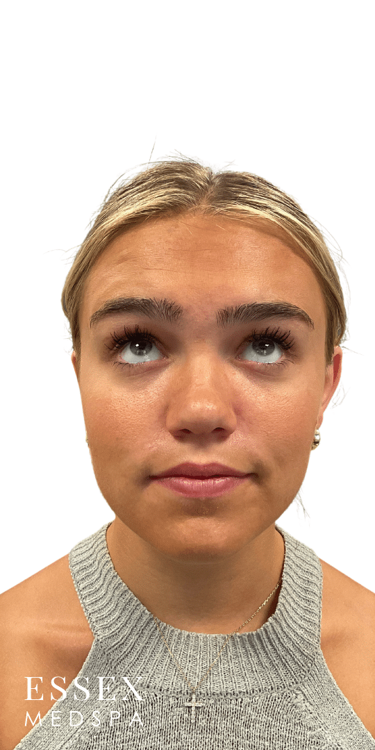 After Image: Neurotoxin – Forehead and Lip Flip - front
