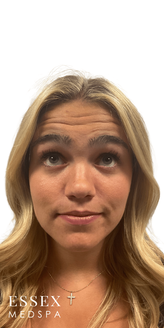 Before Image: Neurotoxin – Forehead and Lip Flip - front