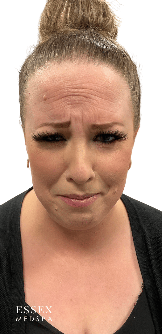 Before Image: Neurotoxin – Forehead and Glabella - front