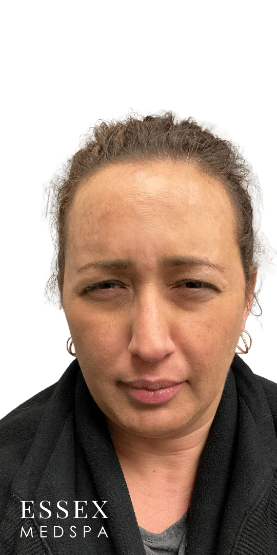 After Image: Neurotoxin – Glabella - front