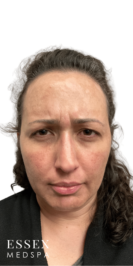 Before Image: Neurotoxin – Glabella - front