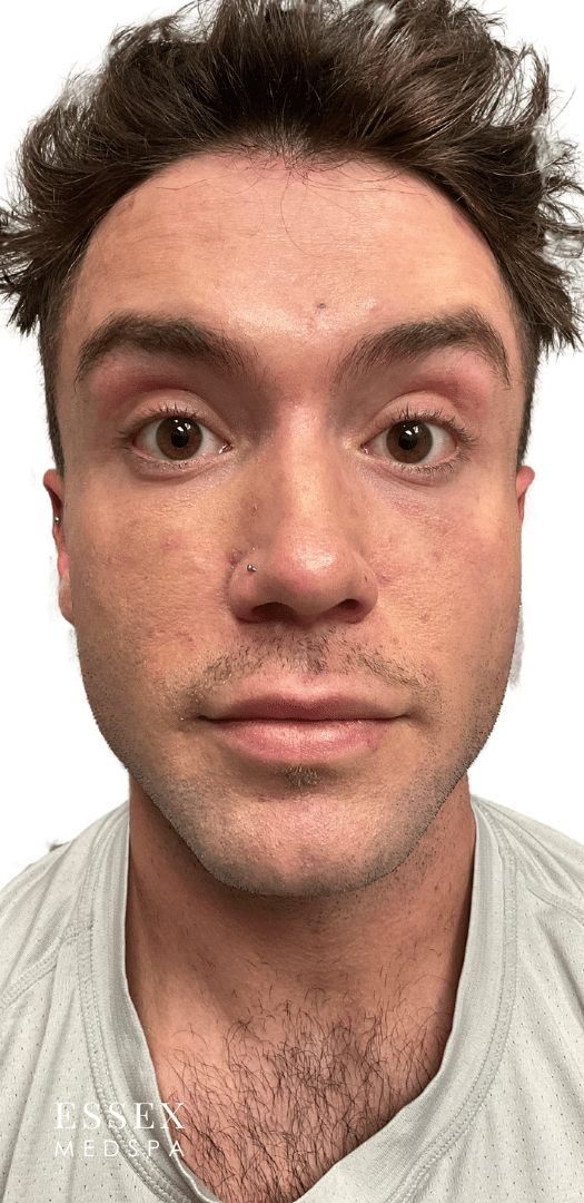 After Image: Neurotoxin – Forehead - front