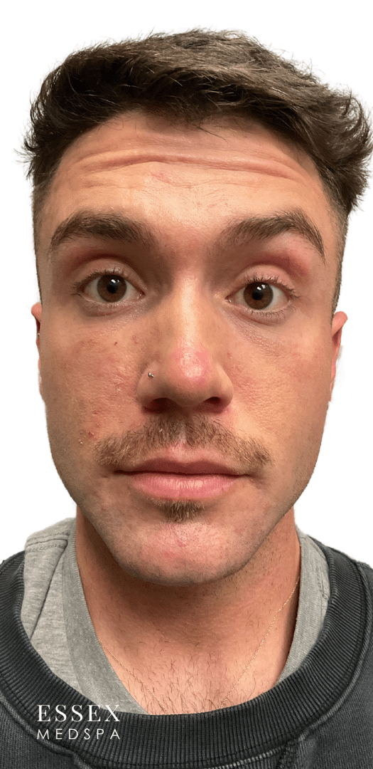 Before Image: Neurotoxin – Forehead - front