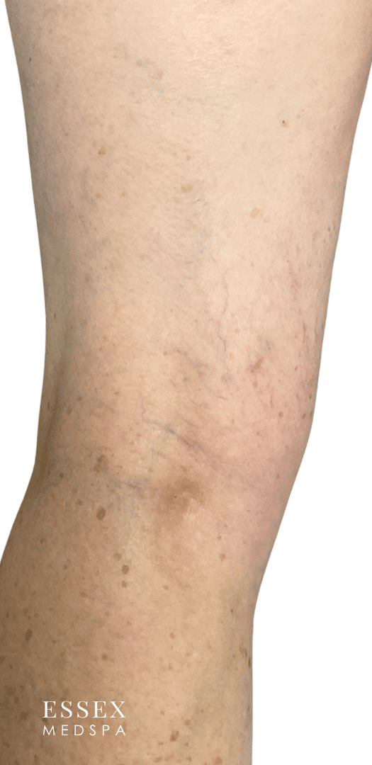 After Image: Sclerotherapy - back