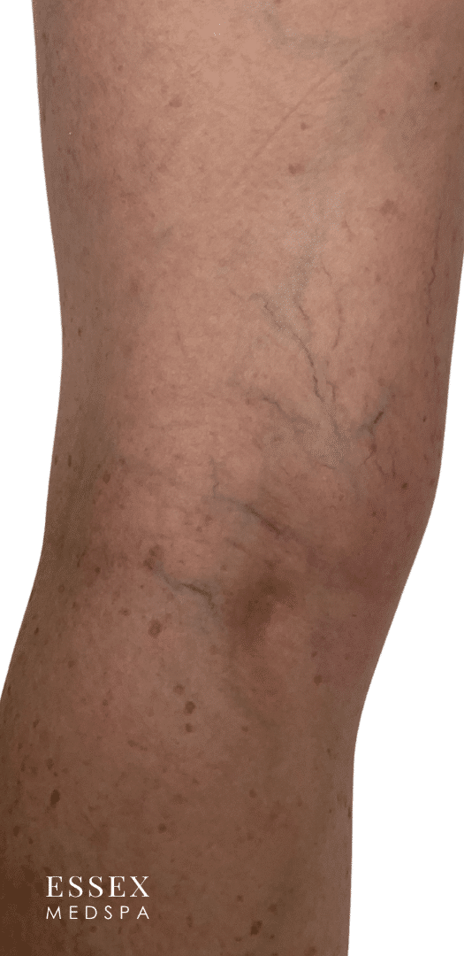 Before Image: Sclerotherapy - back