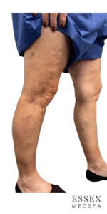 After Image: Sclerotherapy