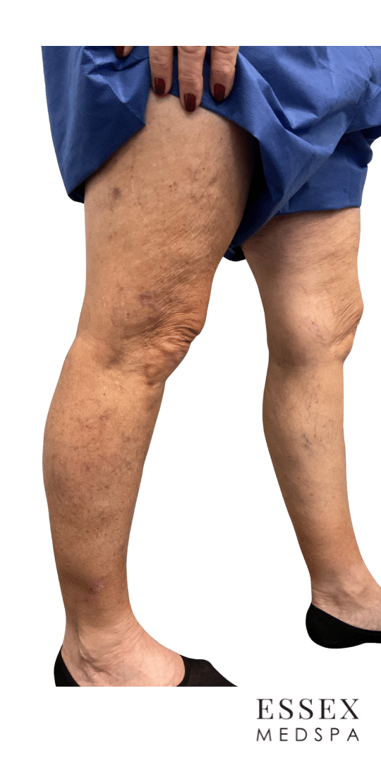 After Image: Sclerotherapy - right-front-oblique