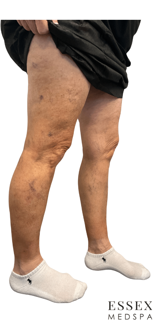 Before Image: Sclerotherapy - right-front-oblique