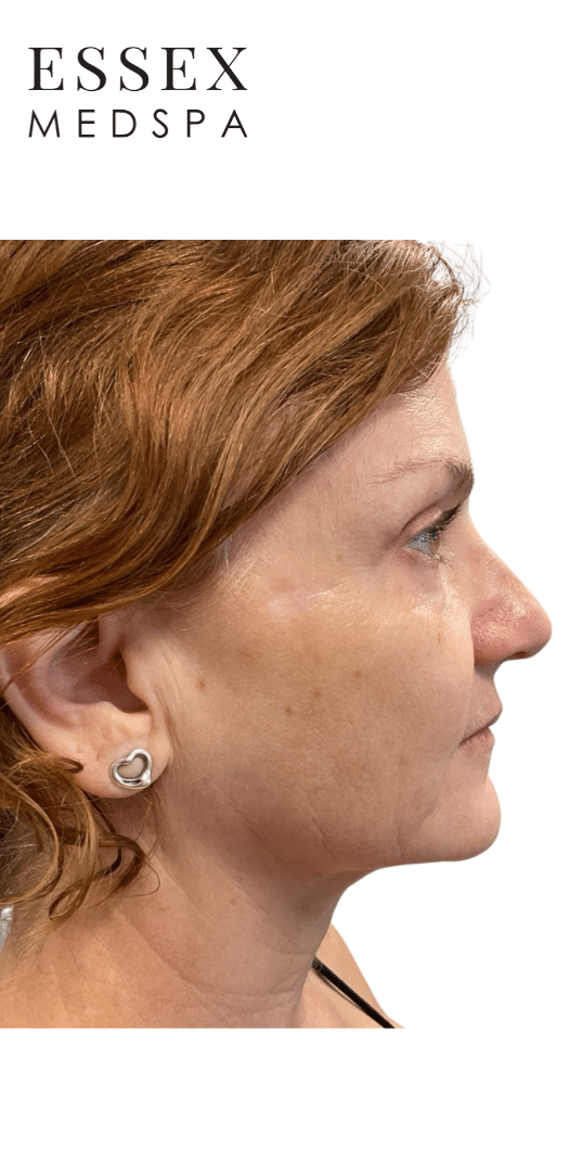 After Image: Sculptra - right-side