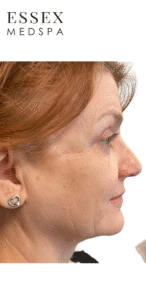 Before Image: Sculptra
