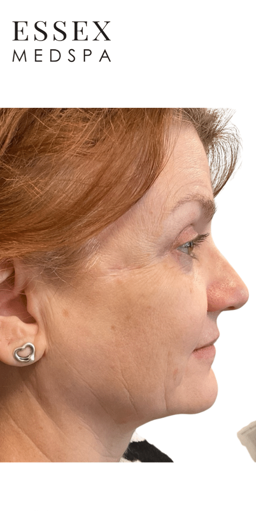 Before Image: Sculptra - right-side