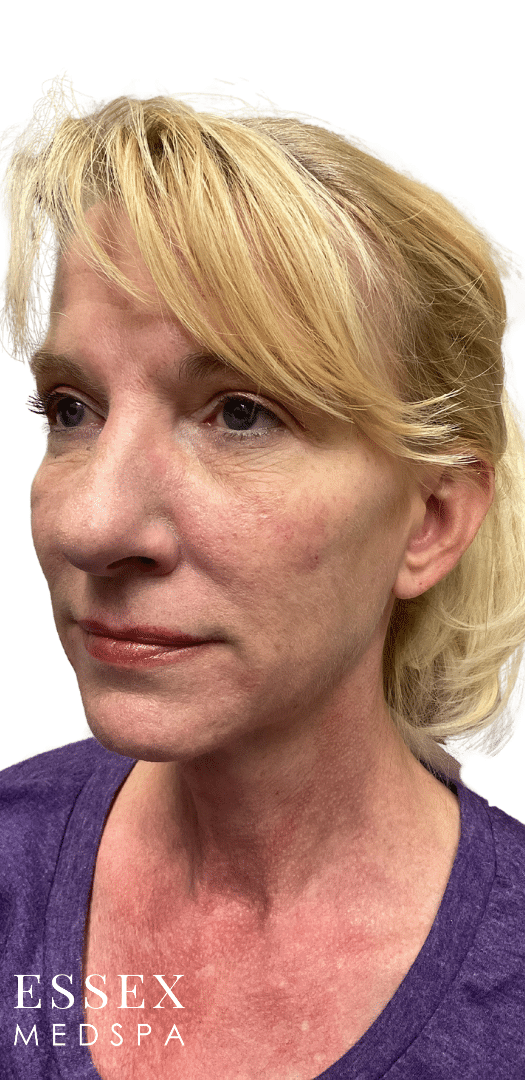 After Image: Sculptra - left-front-oblique