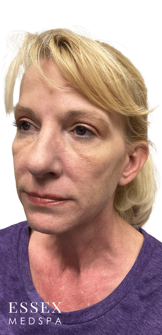 Before Image: Sculptra - left-front-oblique