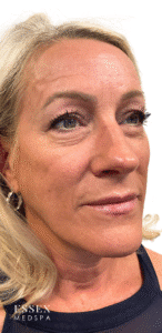 After Image: Sculptra