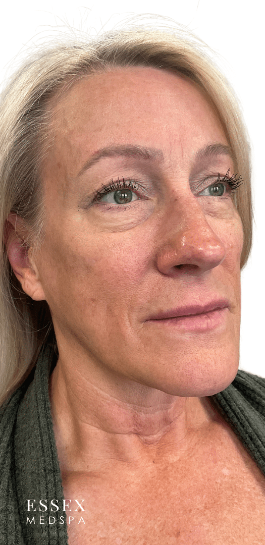 Before Image: Sculptra - right-front-oblique