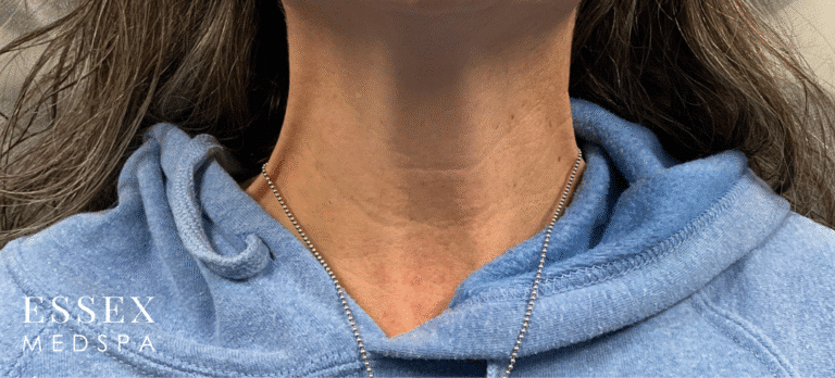 After Image: Tox for Nefertiti Neck Lift - front