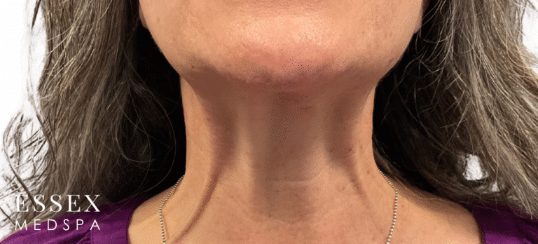 Before Image: Tox for Nefertiti Neck Lift - front