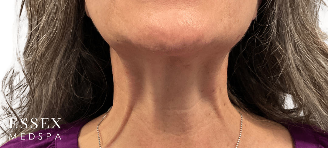 Before Image: Tox for Nefertiti Neck Lift - front