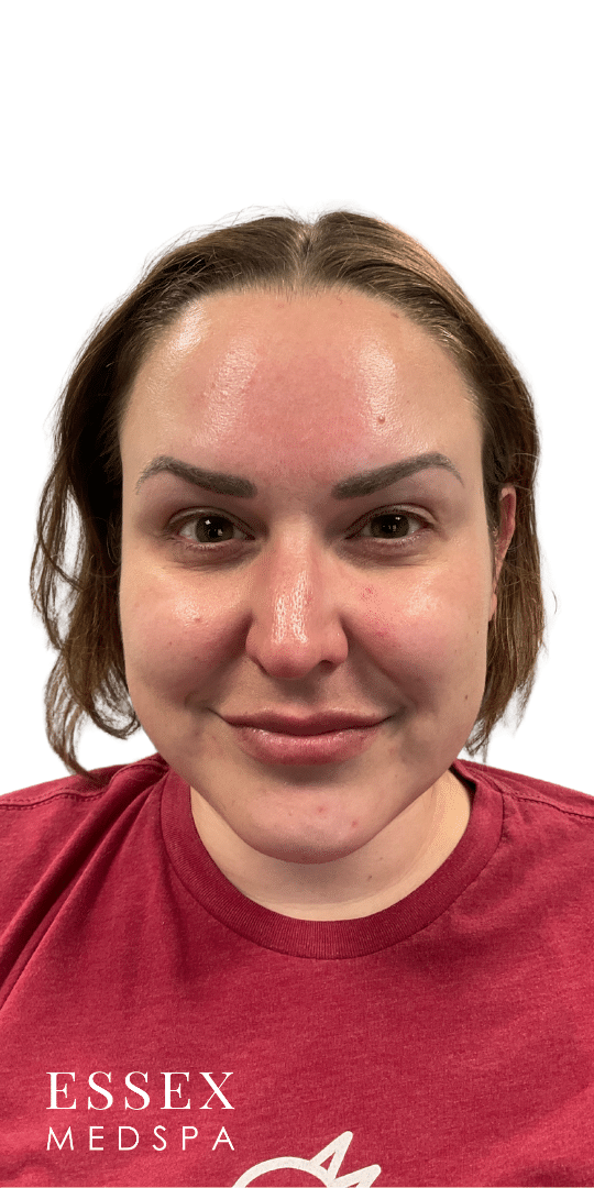 After Image: Neurotoxin – Masseters and Facial Slimming - front