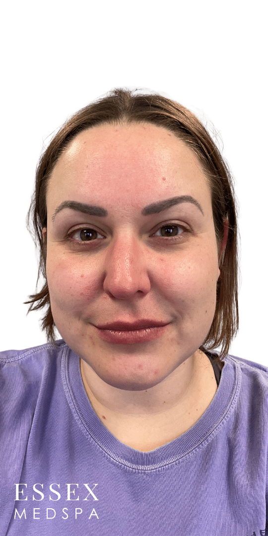 Before Image: Neurotoxin – Masseters and Facial Slimming - front