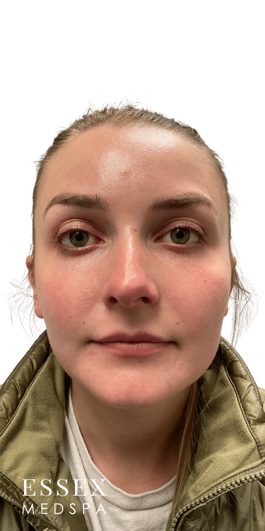 After Image: Neurotoxin – Masseters and Facial Slimming - front