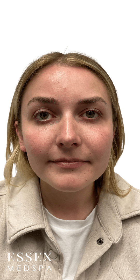 Before Image: Neurotoxin – Masseters and Facial Slimming - front