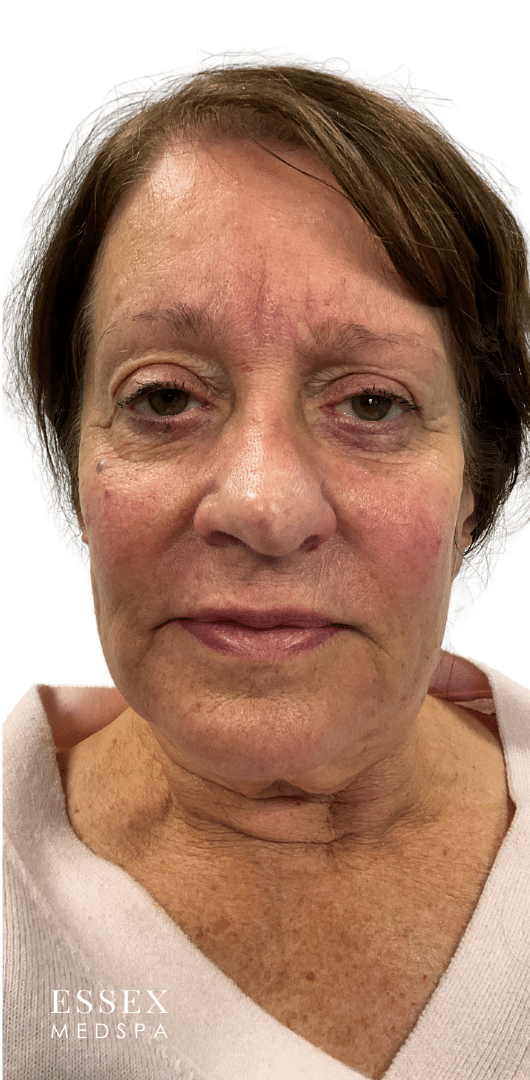 After Image: Derma PRP - front