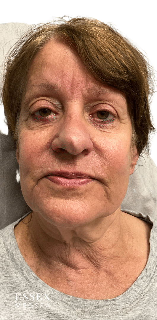 Before Image: Derma PRP - front