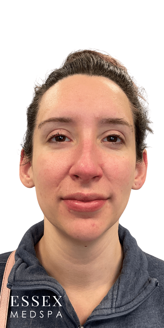 After Image: Dermal Filler for Facial Balancing - front
