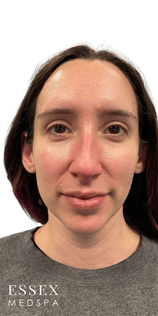 Before Image: Dermal Filler for Facial Balancing - front