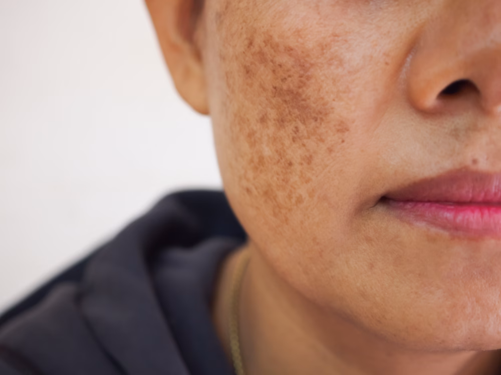 A middle aged woman shows visible signs of skin concerns like melasma, wrinkles, dark spots, and dryness, often treated with a photofacial for skin rejuvenation.