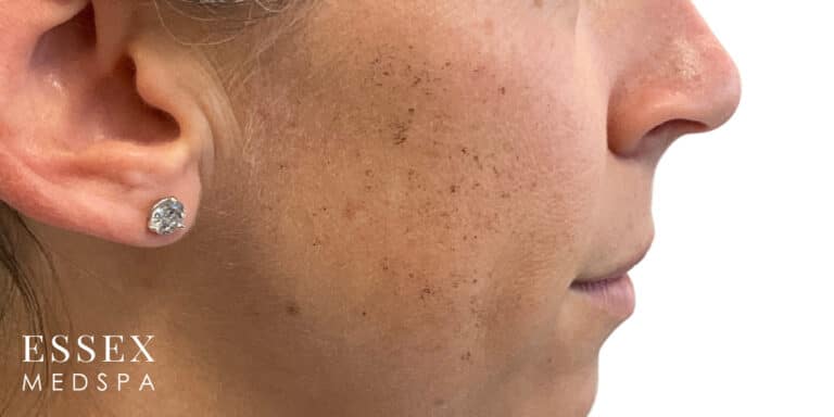 Before Image: IPL - right-side