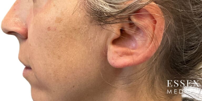 After Image: IPL - left-side