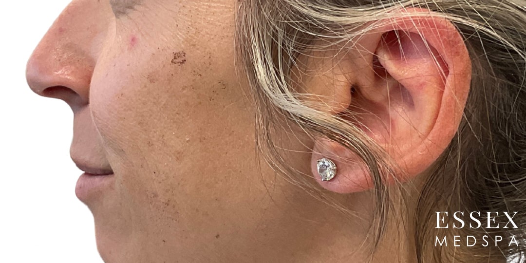 Before Image: IPL - left-side