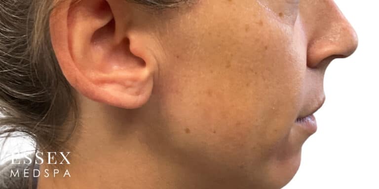 After Image: IPL - right-side