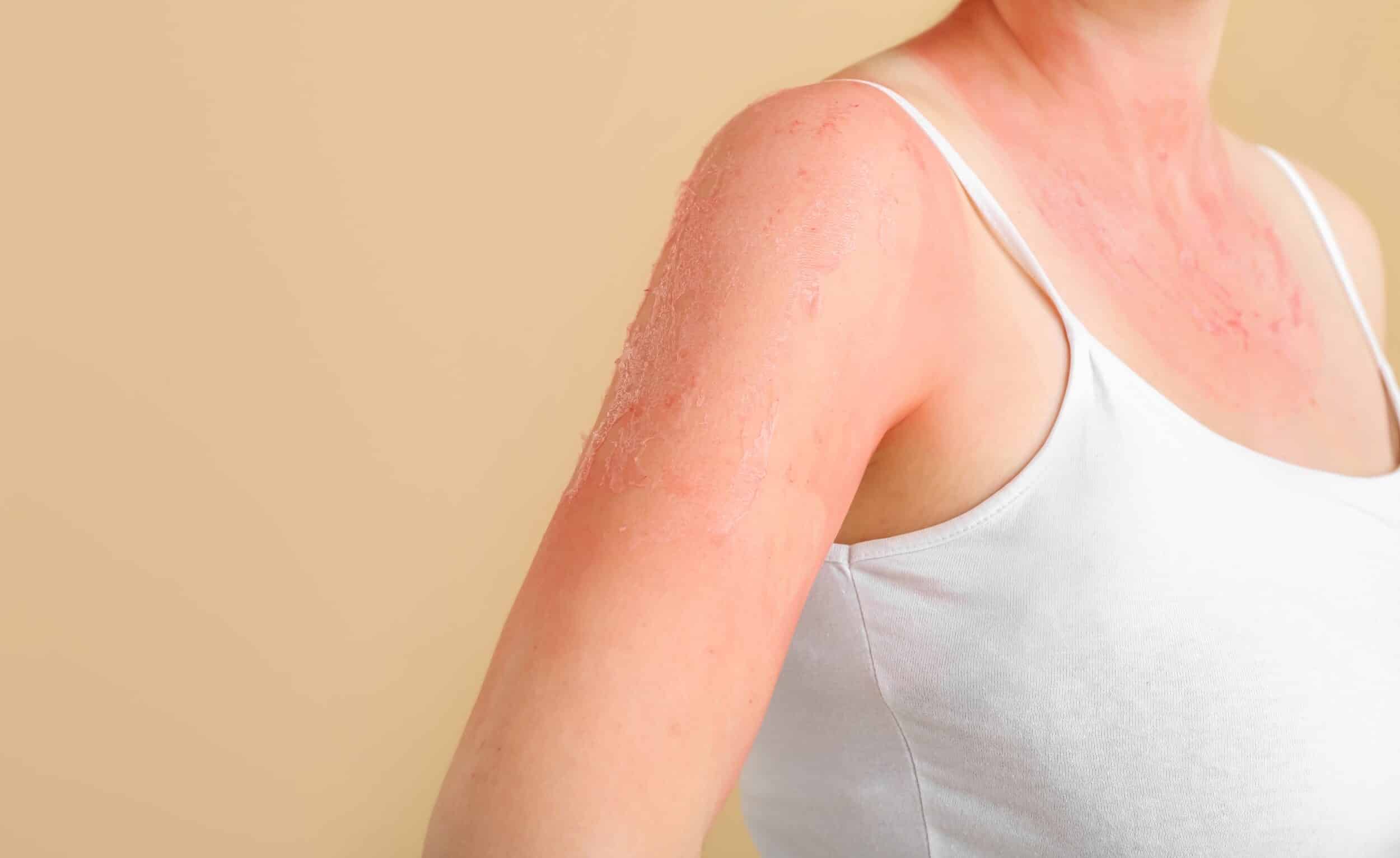 Close-up of woman with red sunburned skin against colored background, showing skin irritation and UV damage