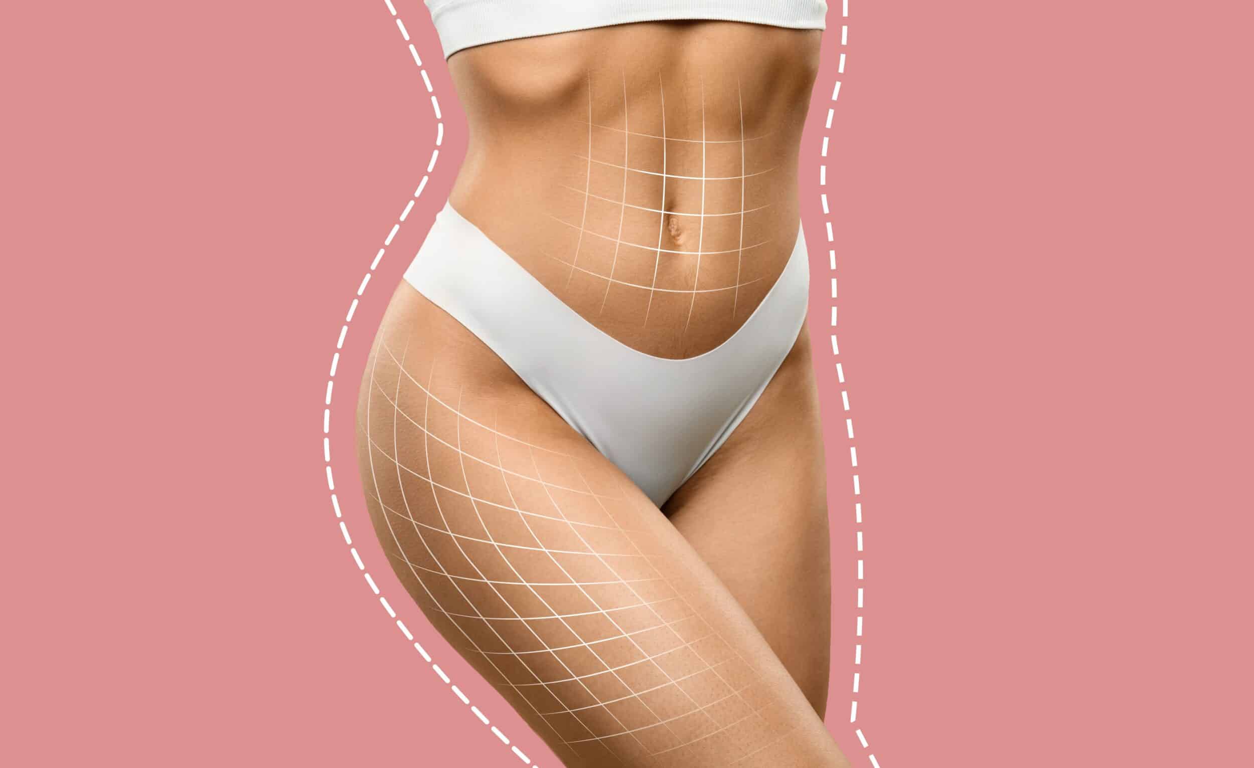 Cropped view of fit woman in white underwear with contouring lines on body, symbolizing Evolve X body shaping and anti-cellulite cosmetic treatment