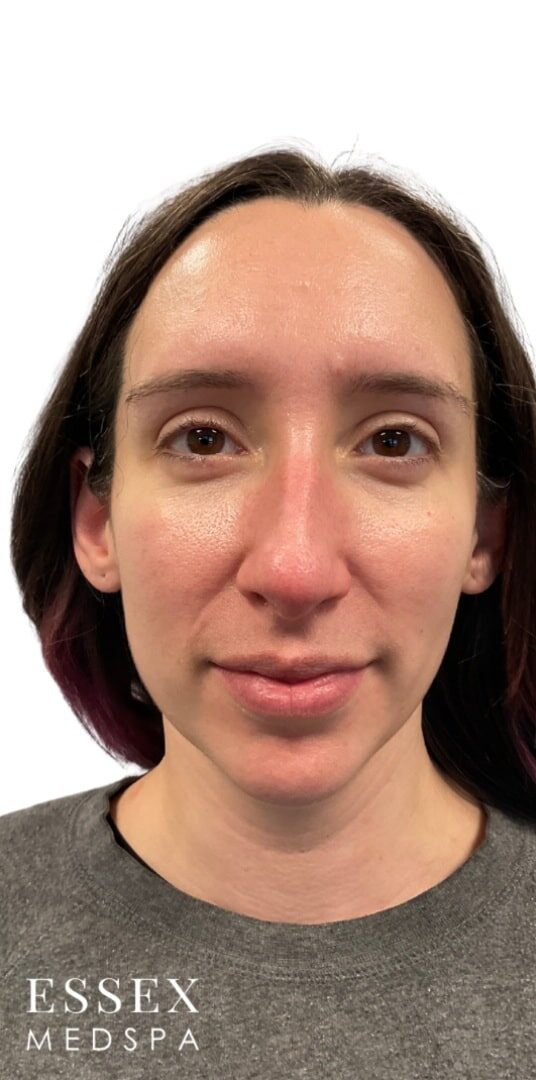 Before Image: Facial Balancing - front