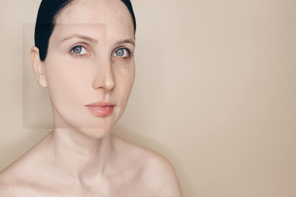 Before and after photo of woman with vascular skin problems showing acne, rosacea, and couperose improvement after cosmetic skincare treatment