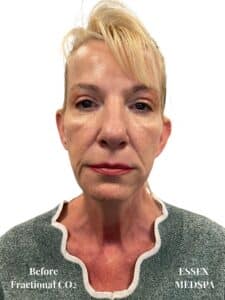 Before Image: Fractional CO2