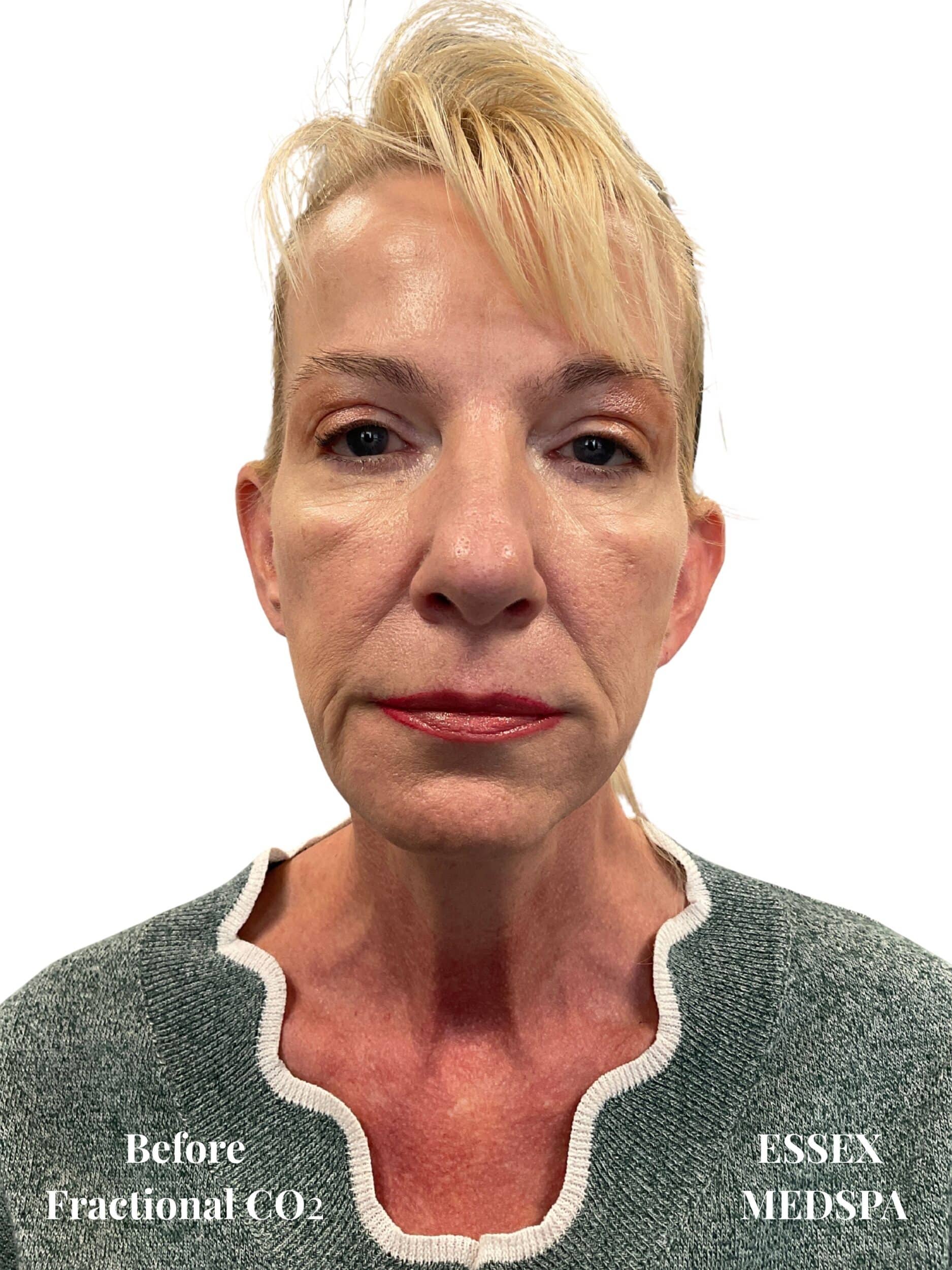 Before Image: Fractional CO2 - front