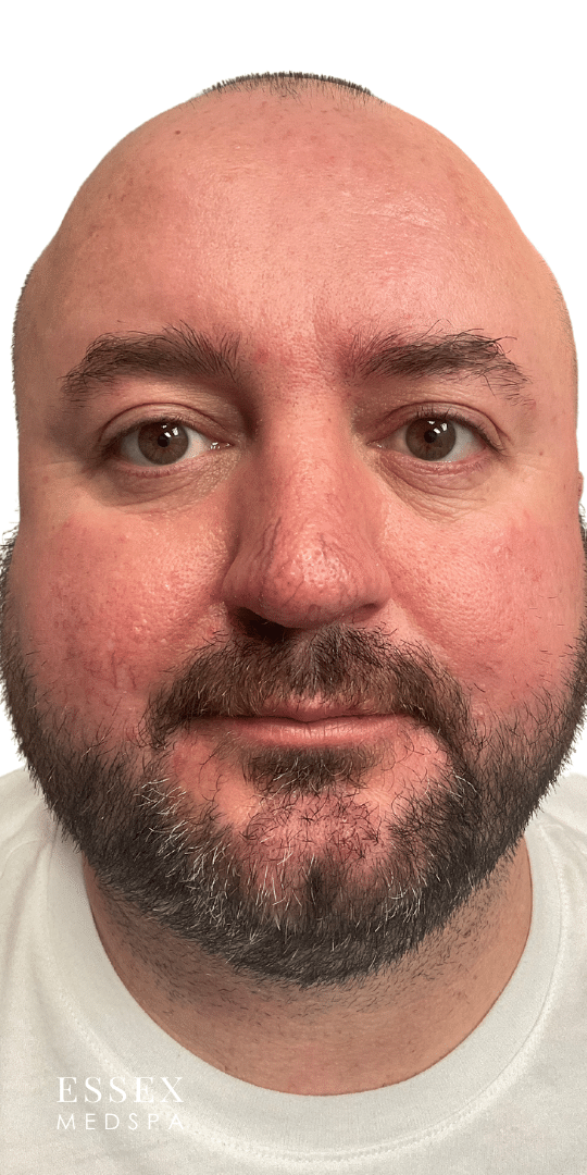 Before Image: IPL - front