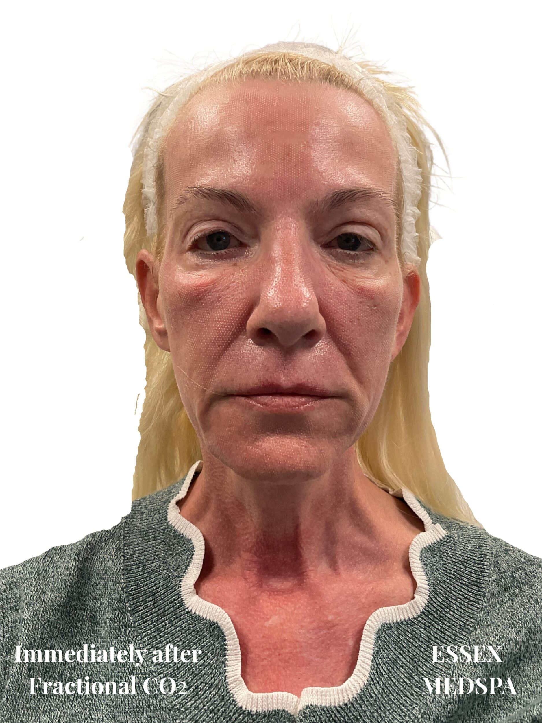 After Image: Fractional CO2 - front