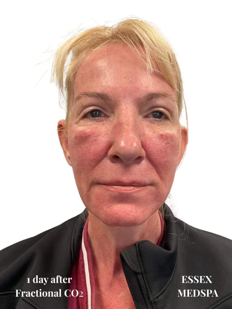 After Image: Fractional CO2 - front