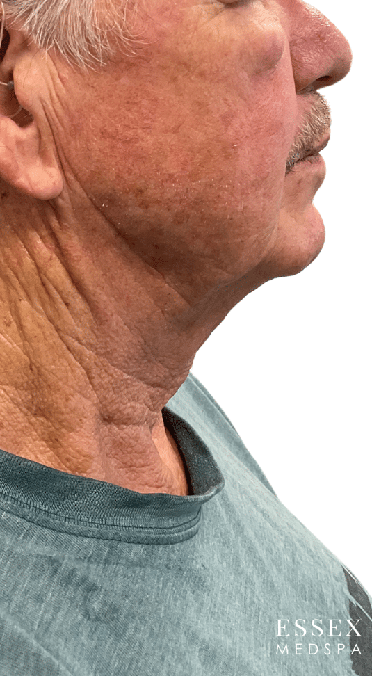 After Image: Derma PRP with Morpheus8 for Neck - front
