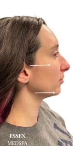 Before Image: Dermal Fillers for Full Facial Balancing