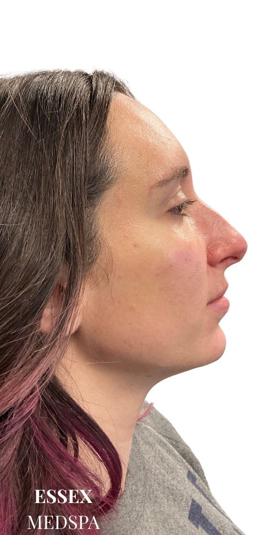 After Image: Dermal Fillers for Full Facial Balancing - front