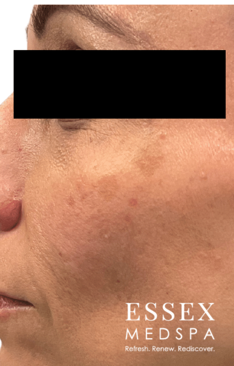 Before Image: Thermolo for Brown Spots - front