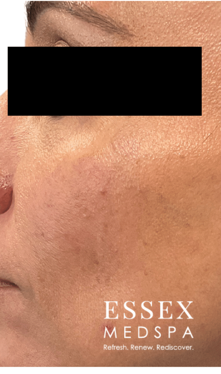 After Image: Thermolo for Brown Spots - front
